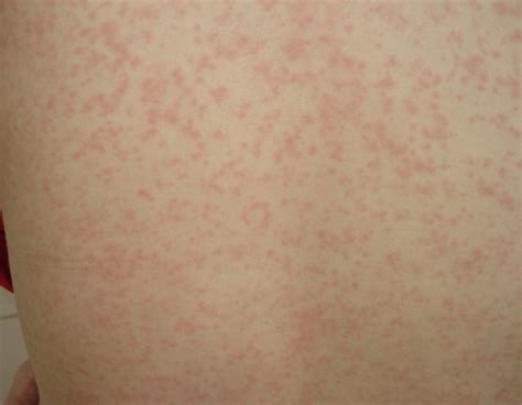 麻疹和急疹图片对比,麻疹是什么样图片_大山谷图库