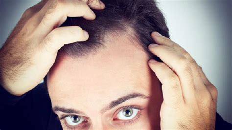 预防秃头的护理方法有哪些 这些方法有效预防脱发秃头 - 复禾健康
