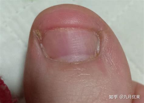 灰指甲的发病原因是什么 如何避免灰指甲传染呢_健康常识_大成皮肤网