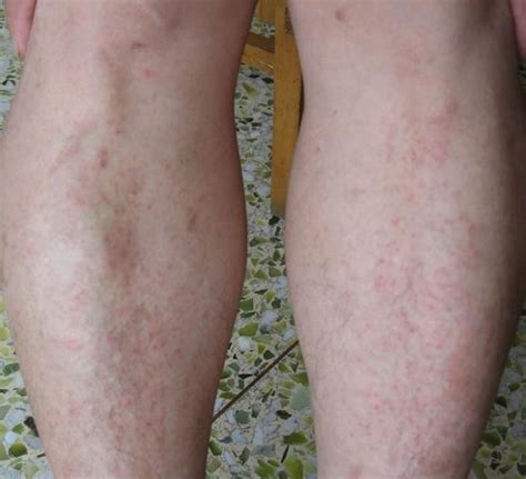 痒痒痒，夏季皮炎高发，皮肤科告诉你为什么|夏季皮炎|皮炎|抗生素_新浪新闻