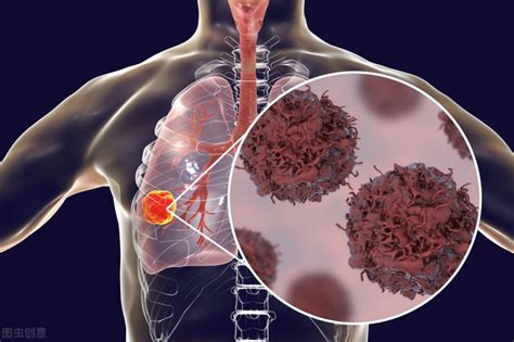 为什么中国人容易得肺癌,肺癌的早期症状有哪些_全球肿瘤医生网