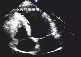 心脏彩超图片