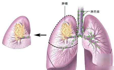 揭示亚实性肺腺癌结节肿瘤微环境特征|细胞|肺腺癌|微环境_新浪新闻