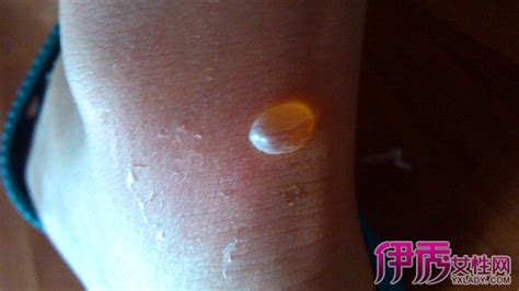 【水泡图片】【图】皮肤起水泡图片 几种皮肤水泡的处理方法(3)_伊秀健康|yxlady.com