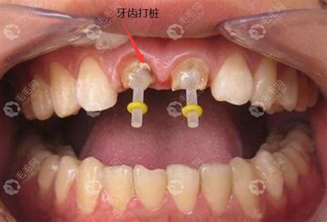 牙齿做根管治疗打桩和做种植牙有什么区别?哪个更牢固些 - 口腔健康 - 毛毛网