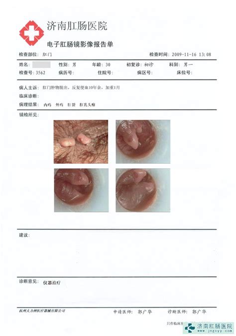 痔疮什么样的图片