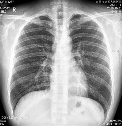 PET-CT如何确诊肺部阴影性质_肿瘤_医生在线