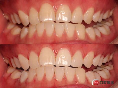 牙齿矫正+牙齿贴面，适合大部分的美牙案例