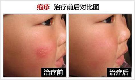 疱疹性皮炎图片