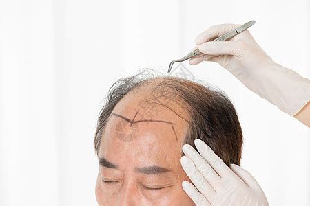 脱发给头皮打针注射的什么?有激素、CGF、头皮营养针3种 - 脱发知识 - 毛毛网