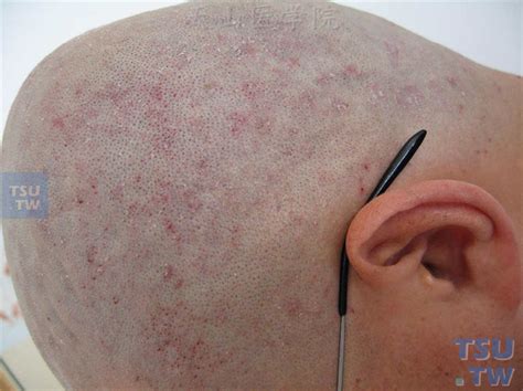 脂溢性皮炎（seborrheic dermatitis）症状表现 - 皮肤病学 - 天山医学院