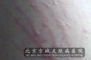 皮肤过敏是由什么原因引起的_过敏_北京京城皮肤医院(北京医保定点机构)