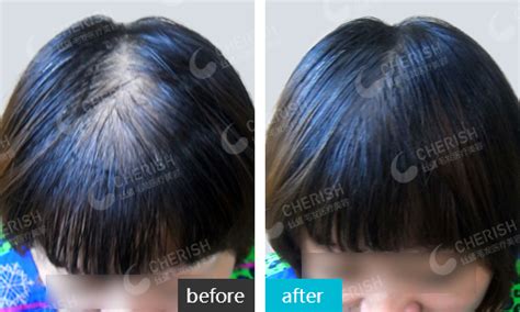 植发科普：头发种植的密度是不是越高术后效果就越好？-发友网