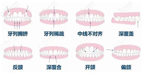 吸附性义齿和普通义齿有啥区别?固定方式及外观都有差别 - 口腔资讯 - 牙齿矫正网