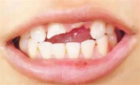 乳牙拔出后，牙根却不完整,这是为什么呢？