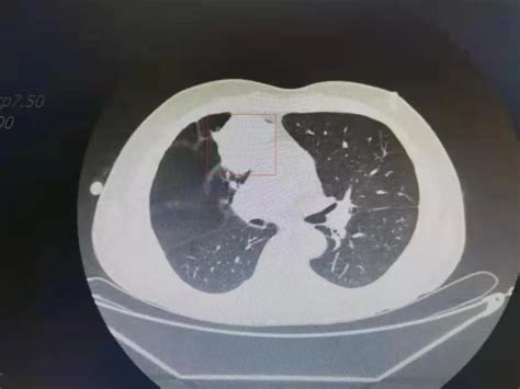 梅州市人民医院 肺癌内科治疗专家吴国武：靶向治疗肺癌，更精准副作用更小