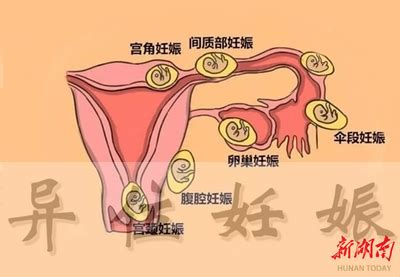 停经、腹痛、阴道流血，这是异位妊娠三联征…… - 健康科普 - 新湖南