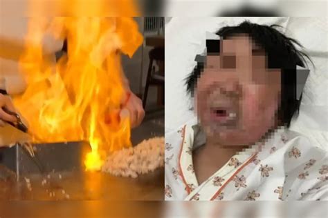 日本一厨师表演“喷火秀”酿祸，火焰冲向父子二人，5岁男童半张脸烧黑脱皮