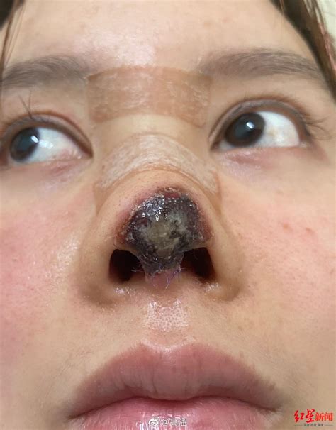 【图】鼻子整形有几种 要避免整形后遗症找上你_鼻子整形有几种_女物美容网|nvwu.com
