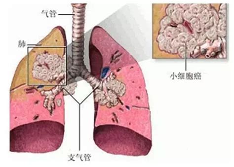 肺小细胞癌