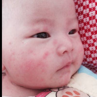 婴儿满脸疹子,婴儿疹子图片,婴儿辅食过敏小疹子图_大山谷图库