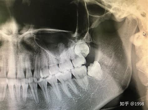 正常的智齿图片