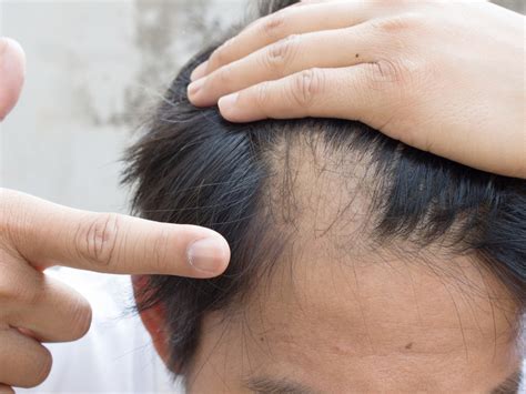 这项诺奖技术，成功应用于治疗脱发，被评价为可彻底改变头发再生的重大突破_风闻