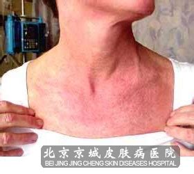 蛇串疮图片