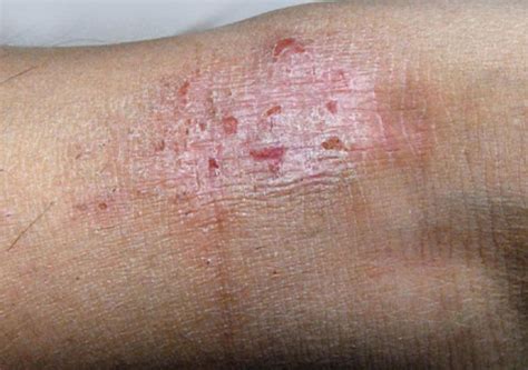 5种皮肤一小块粗糙干皮癣图片原因症状用什么药膏治疗