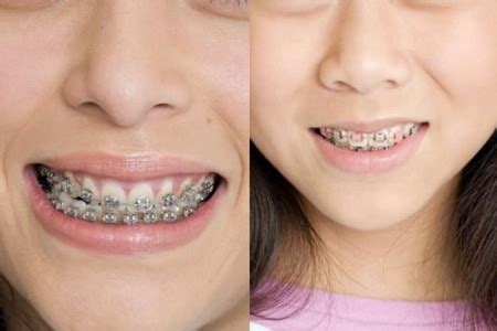 【图】牙套要戴多长时间 影响的因素有哪些_牙套_女物美容网|nvwu.com