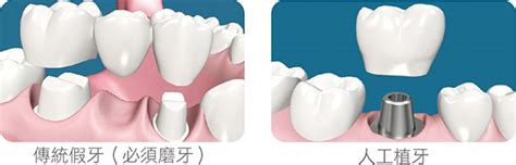 2023口腔医院镶牙价格表全新发布：含活动义齿/固定假牙/种植牙费用 - 21怡口美牙网