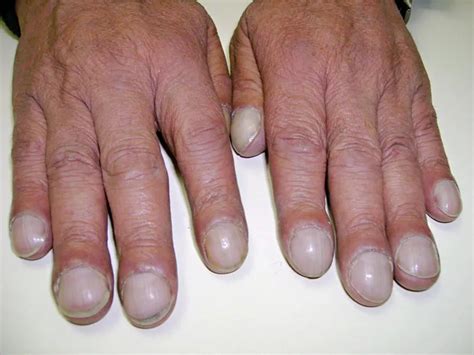 指甲发现癌症,得症人的指甲图片,健康的指甲图片_大山谷图库