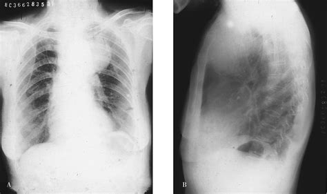 中央型肺癌的CT表现_图片