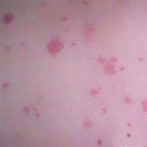 常见的疹子类型及图片,过敏疹子的症状图片,皮疹种类及症状图片_大山谷图库