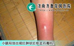 丹毒早期症状图片