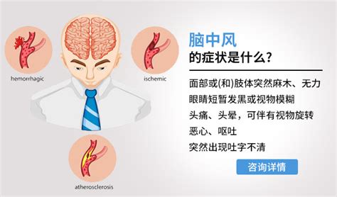 脑中风的症状是什么_上海蓝十字脑科医院_同济大学附属脑科医院（筹）