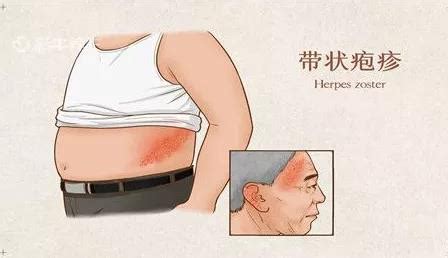 海医科普 | 痛痒难耐的“缠腰龙”—— 带状疱疹 健康科普 -北京市海淀医院