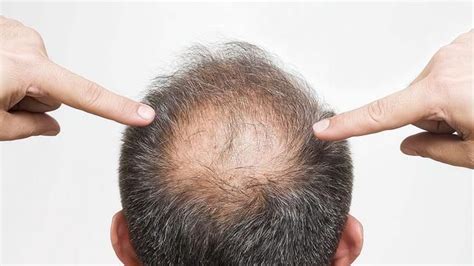 为什么科学家公认“阉割”能解决中年秃顶?