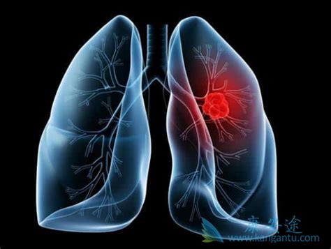 当出现以下肺癌晚期症状时患者生活可能即将结束-康安途海外医疗