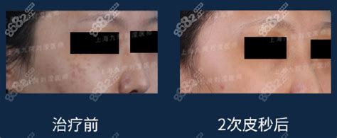 [上海九院激光美容科]2次皮秒激光治疗颧部褐青色斑对比图,皮肤治疗对比照-8682赴韩整形网