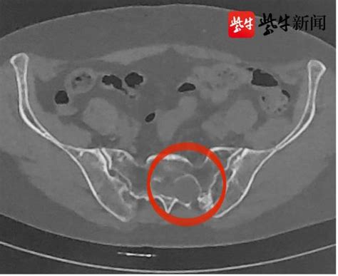 六旬阿姨腰背疼痛、小腹坠胀……竟是这个部位长了囊肿|神经外科_新浪新闻