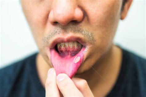 丑陋男人嘴部疼痛的aphtha溃疡复制文本的空间高清图片下载-正版图片502943172-摄图网