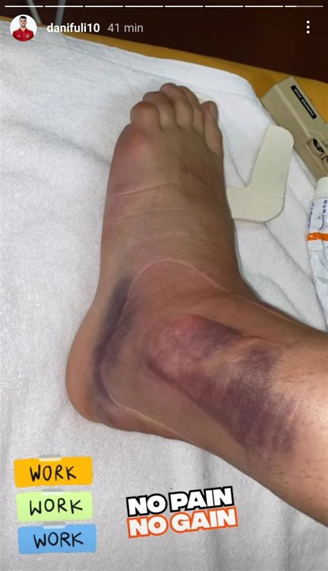 塞巴略斯晒脚踝伤势图，仍可见肿胀和淤青-直播吧zhibo8.cc