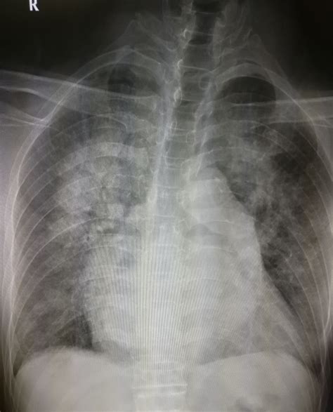 鉴别「肺部病变的感染与非感染」对临床决策至关重要，如何挖出诊治线索？呼吸科医生对影像学特点应有哪些独特理解？-å­¦æœ¯-呼吸界