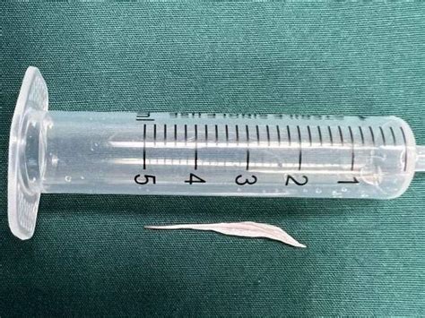 女子鱼刺卡喉，3天后刺穿食管直B颈总动脉-中国健康