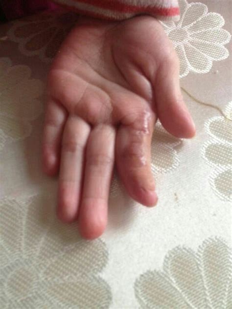 小手指内弯,食指是哪个手指,宝宝小拇指内弯图片_大山谷图库