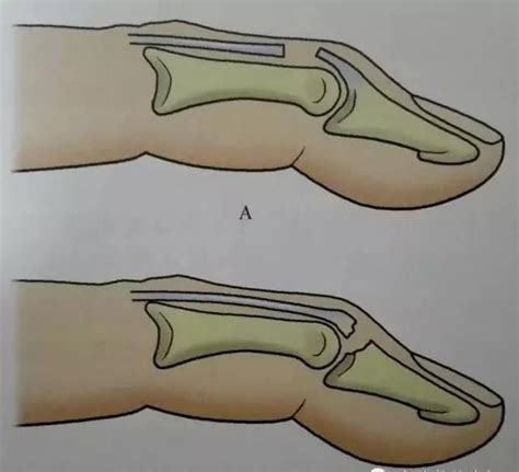 三分钟带你了解手外科常见的疾病：锤（槌）状指_合肥经开普仁外科医院