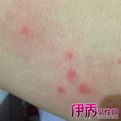 红疙瘩识别图片