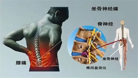 腰椎间盘突出最好的治疗方法 三种方法供你参考_手机新浪网
