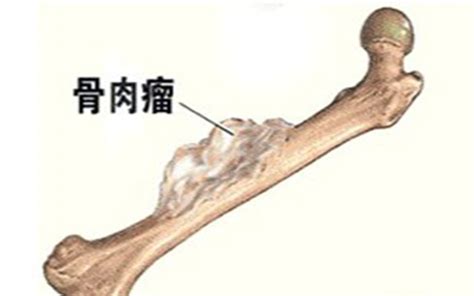 骨肿瘤图片